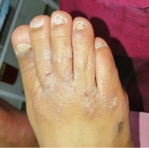 DERMATOMICOSIS-2.jpg