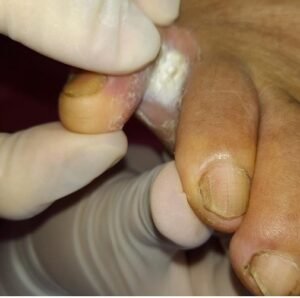 DERMATOMICOSIS-4.jpg