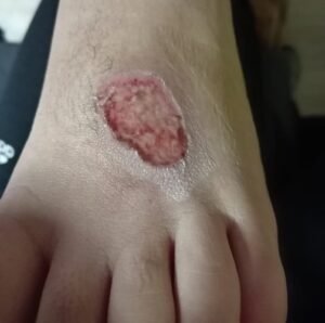 HERIDAS-ULCERAS-6.jpg