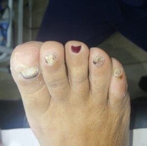 ONICOMICOSIS-11.jpg